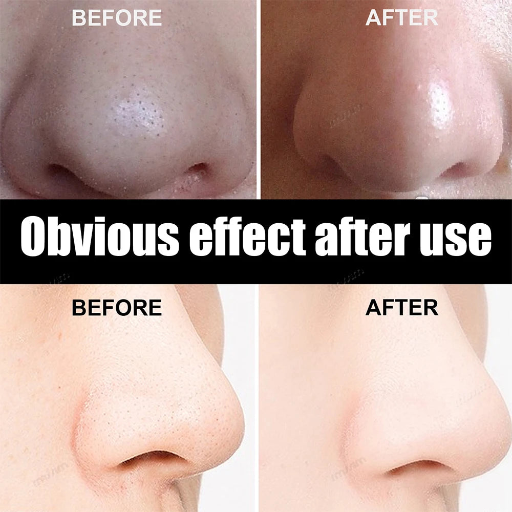 Blackhead Remove Mask Peel Nasal